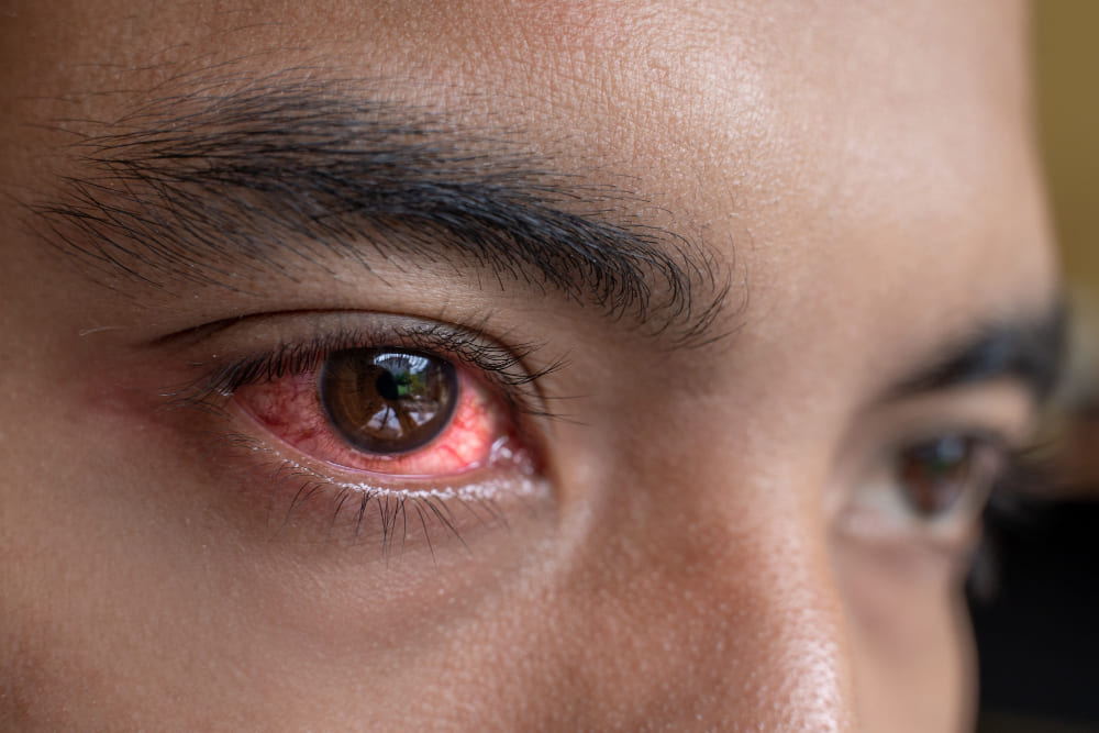 Evaluación y manejo de conjuntivitis en Ensenada, B.C: Diagnóstico y tratamiento oportuno